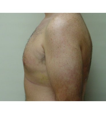 gynecomastio after